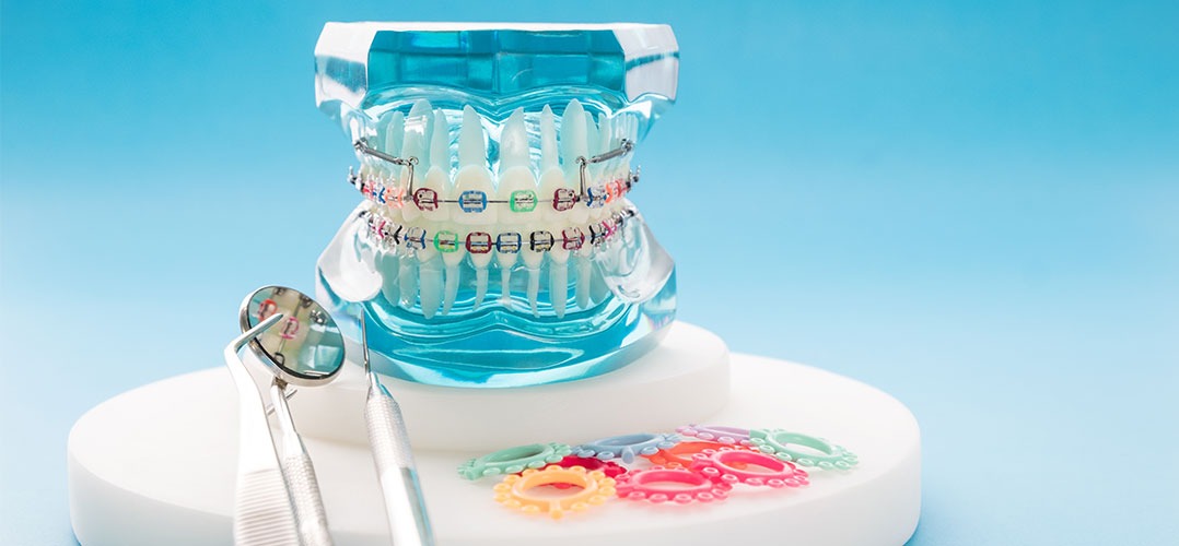 Tips para elegir colores de brackets
