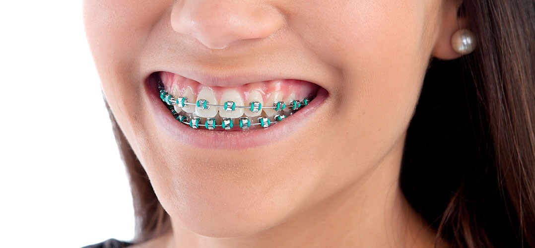 Colores de brackets para mujer