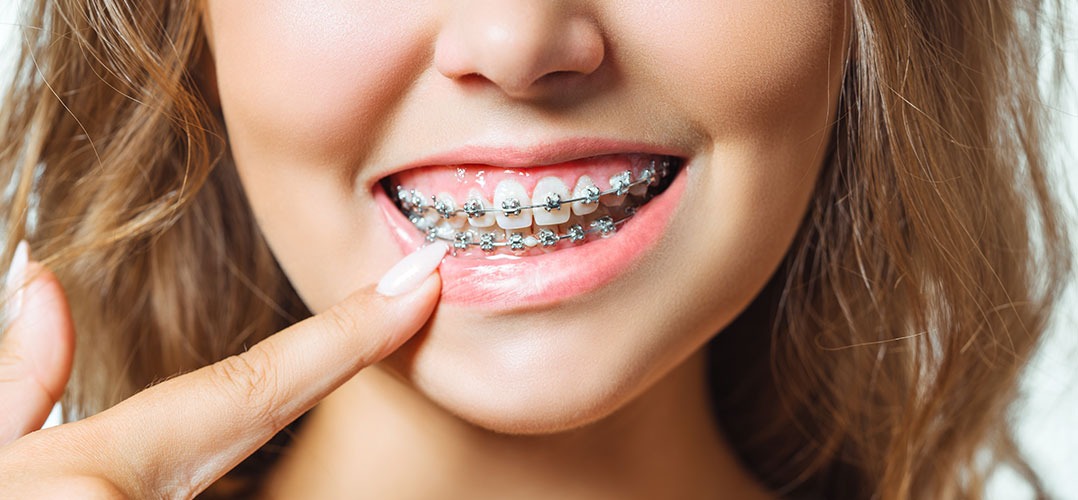 ¿Cómo quitarte los brackets en casa?