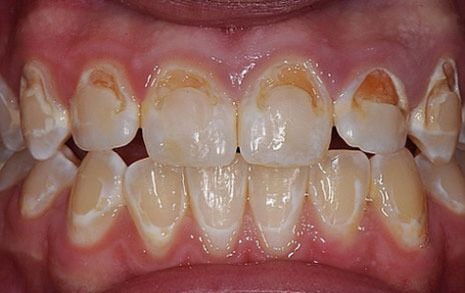 Brackets con figuras